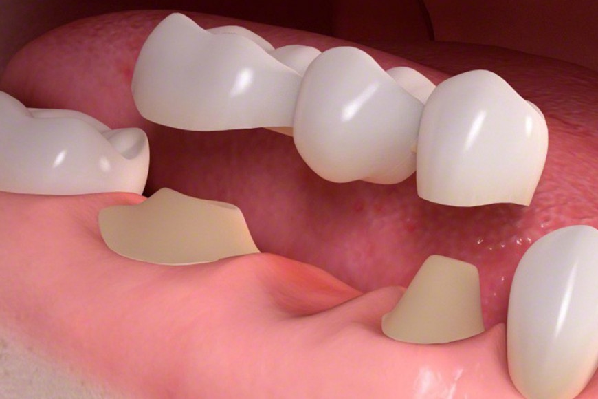 invisalign
