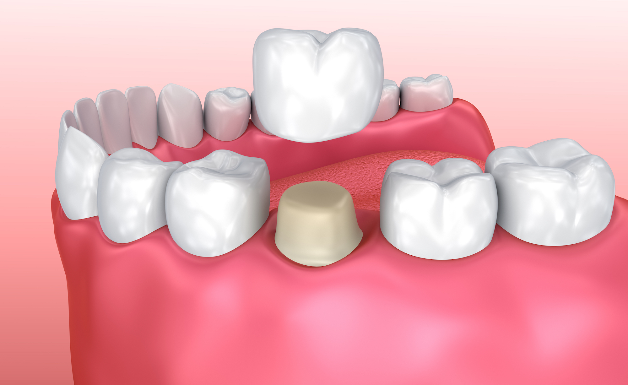 veneers