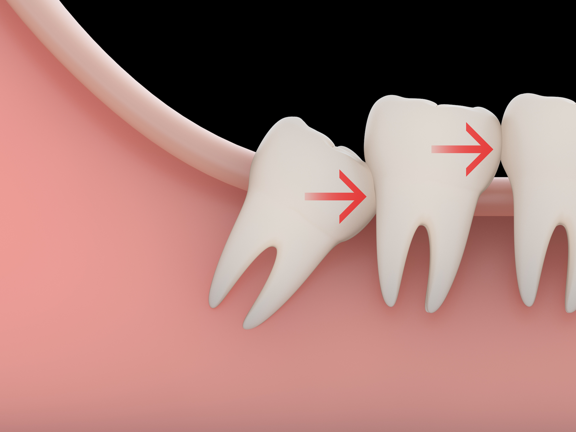 veneers
